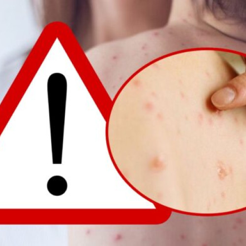 13 985 de cazuri de rujeolă confirmate în România, cu 3 decese înregistrate în judeţul Giurgiu".