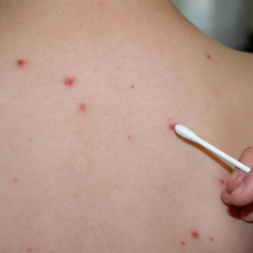 Românii nu se tem de rujeolă, deși boala este extrem de contagioasă și mortală