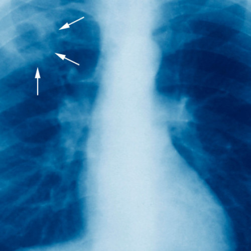România, campioană europeană la numărul de bolnavi de TBC, ține sub cheie aparatura de diagnosticare