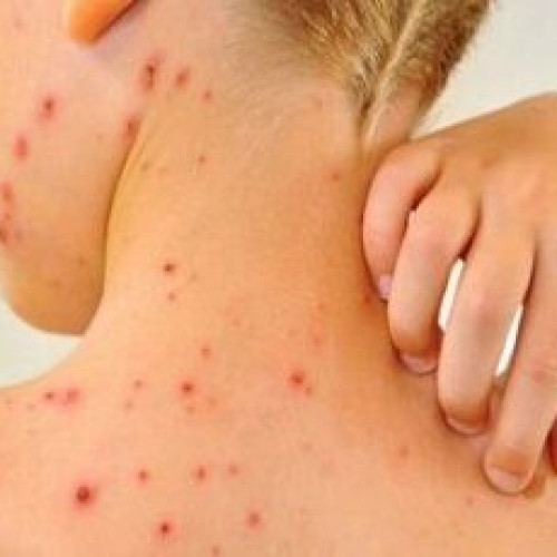 Peste 580 de cazuri noi de rujeolă raportate în ultima săptămână în România