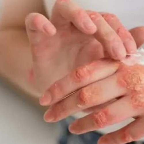 Lepra afectează anual 200.000 de oameni la nivel mondial