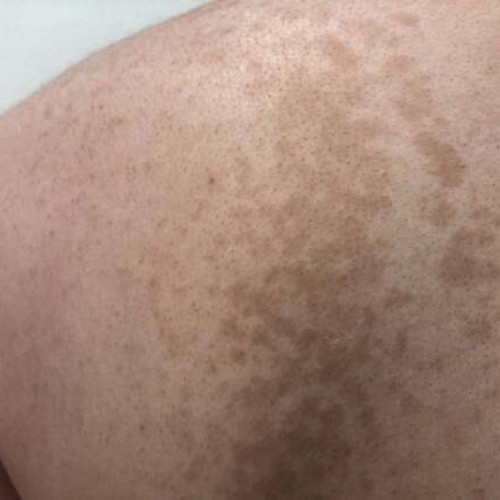 Ce este pitiriazisul versicolor și cum poate fi tratat?