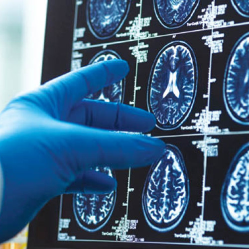 Studii recente: Menopauza și efectele asupra sănătății creierului