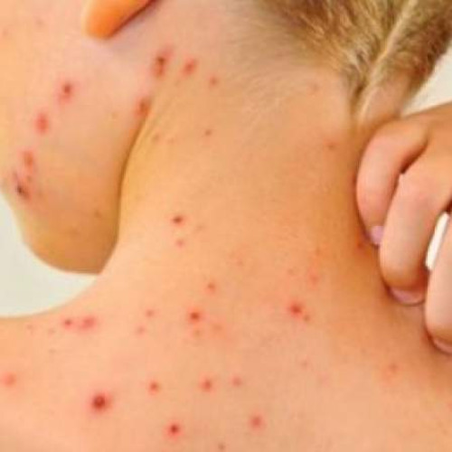 România se confruntă cu 85% din cazurile de rujeolă din Europa