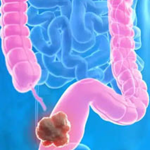 Legătura dintre un virus și cancerul colorectal confirmată de un studiu