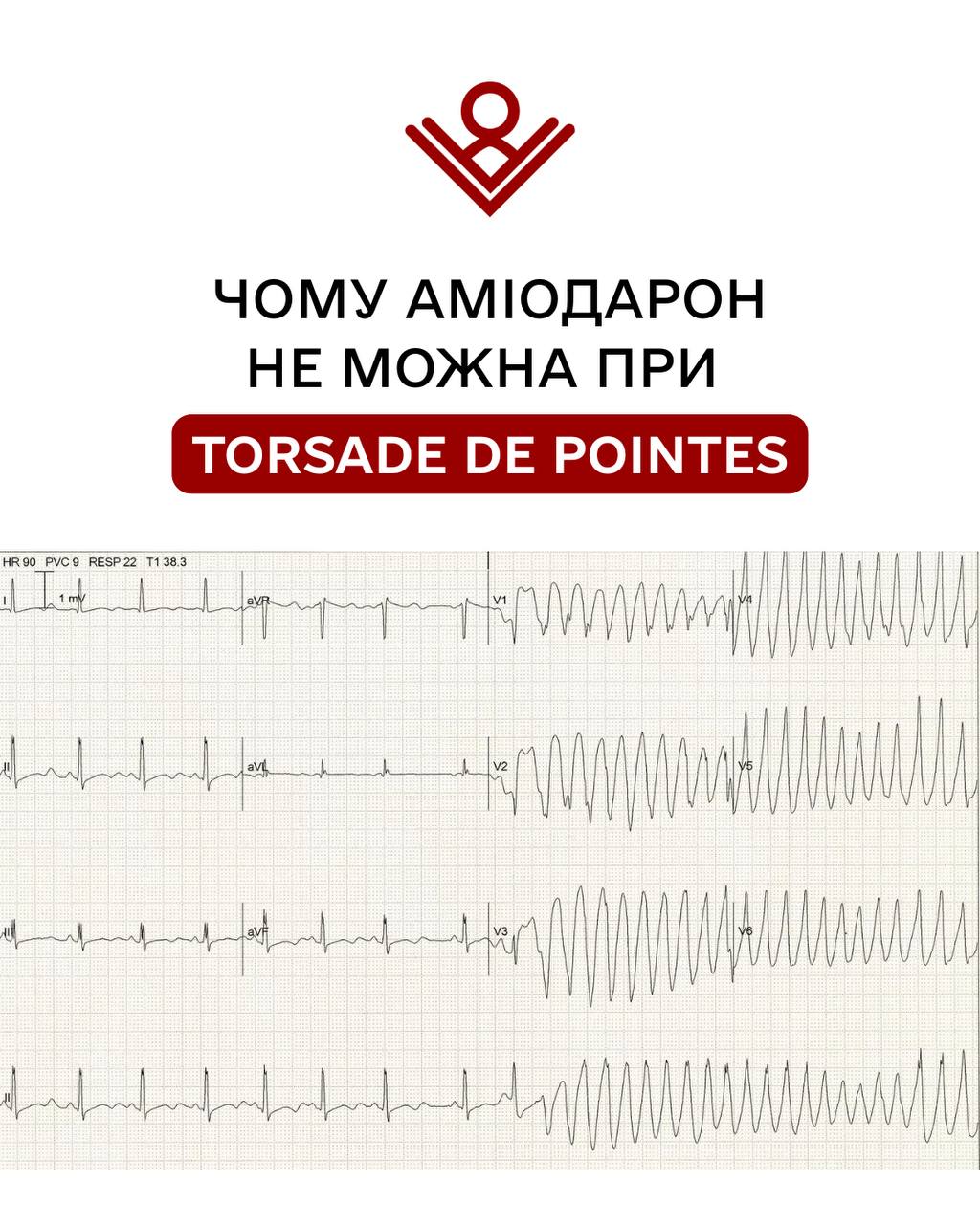 Аміодарон при Torsade de Pointes