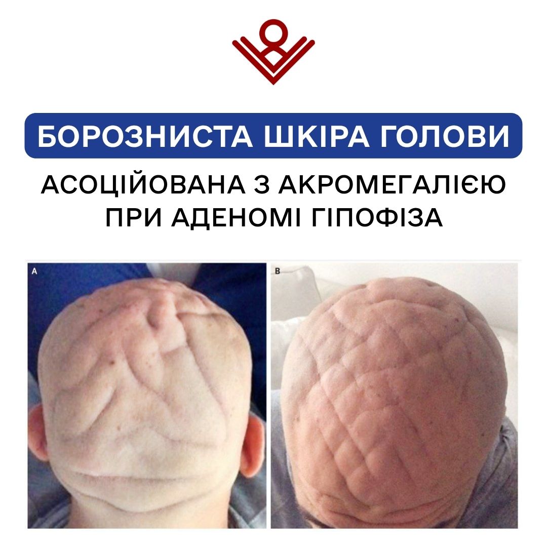 Борозниста шкіра голови