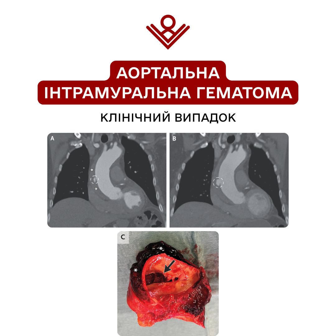 Аортальна інтрамуральна гематома