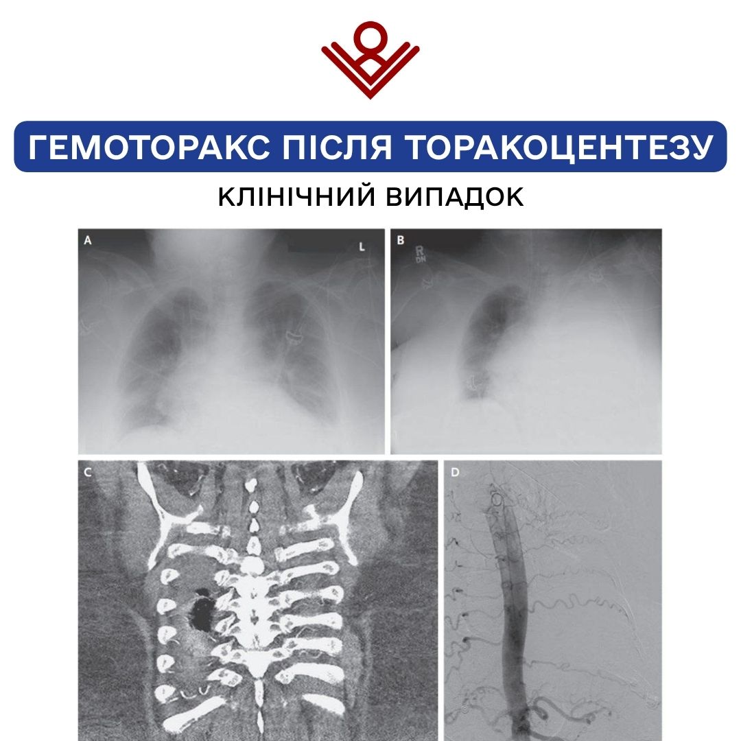 Гемоторакс після торакоцентезу