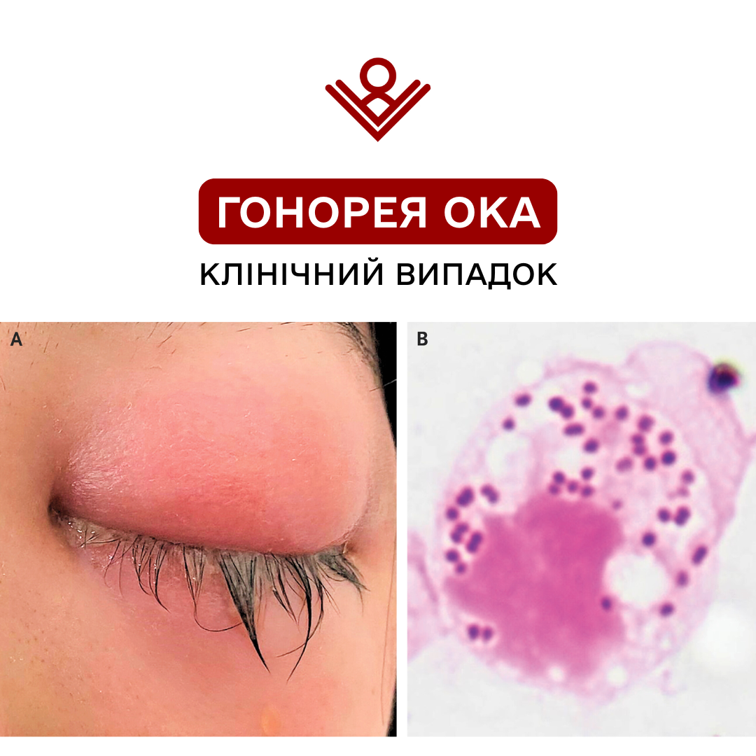 Гонорея ока
