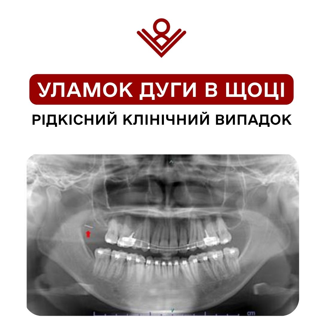 Уламок дуги в щоці