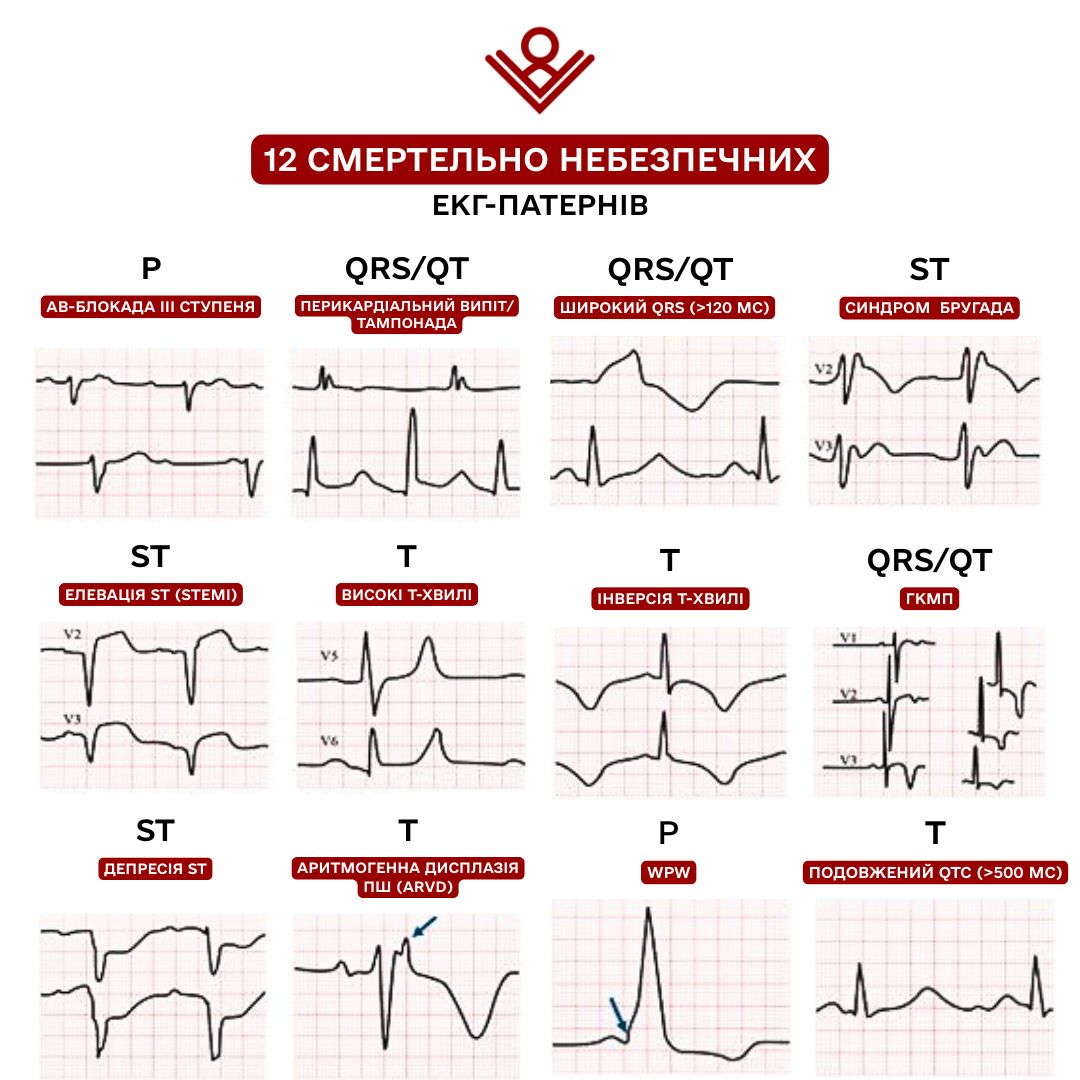 Смертельні ЕКГ-патерни