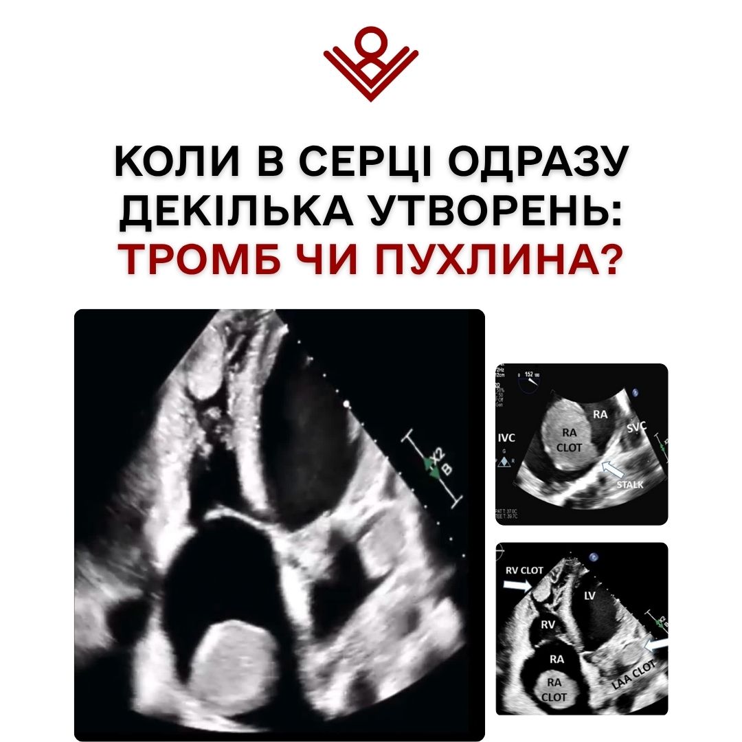 Коли в серці одразу декілька утворень: тромб чи пухлина?