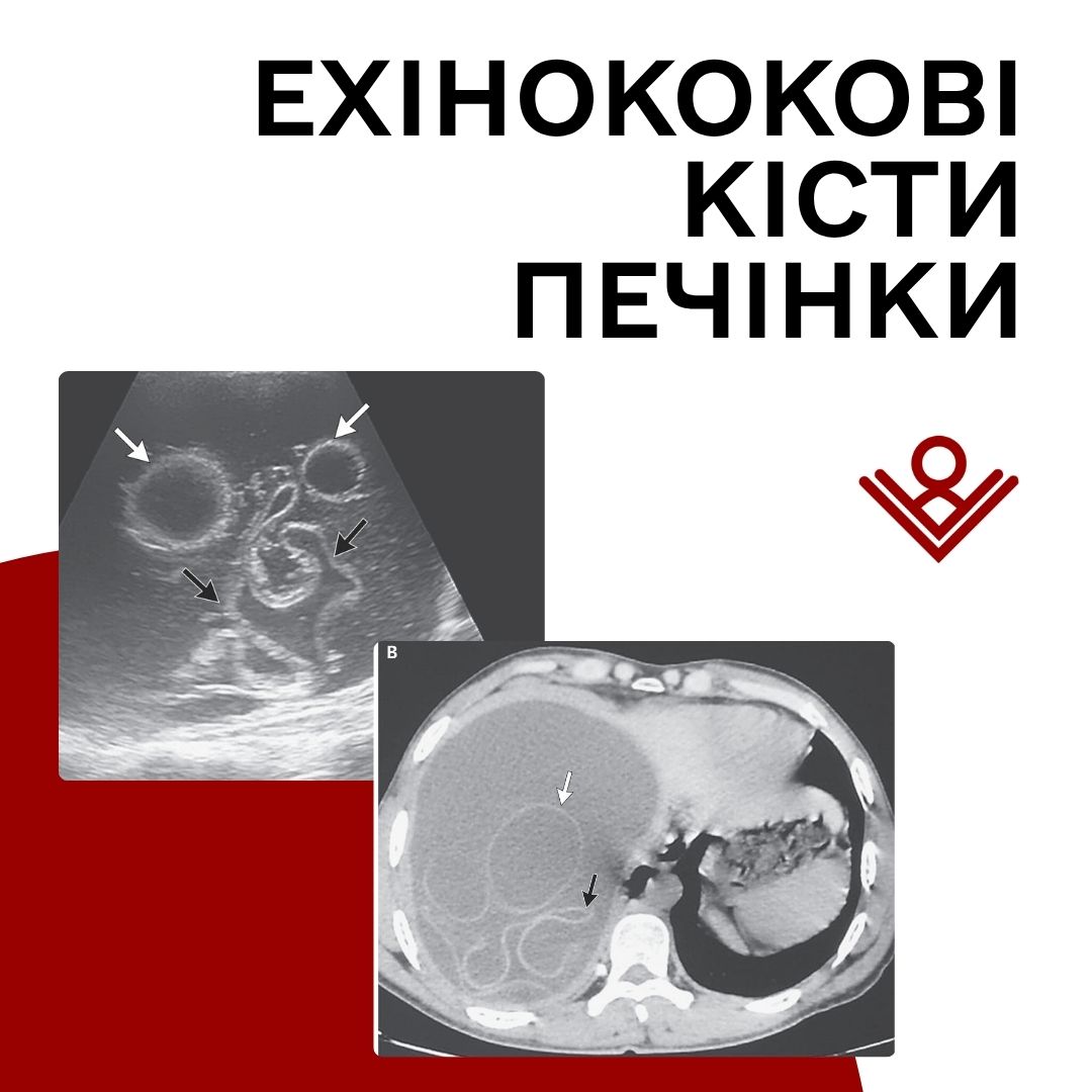 Ехінококові кісти печінки