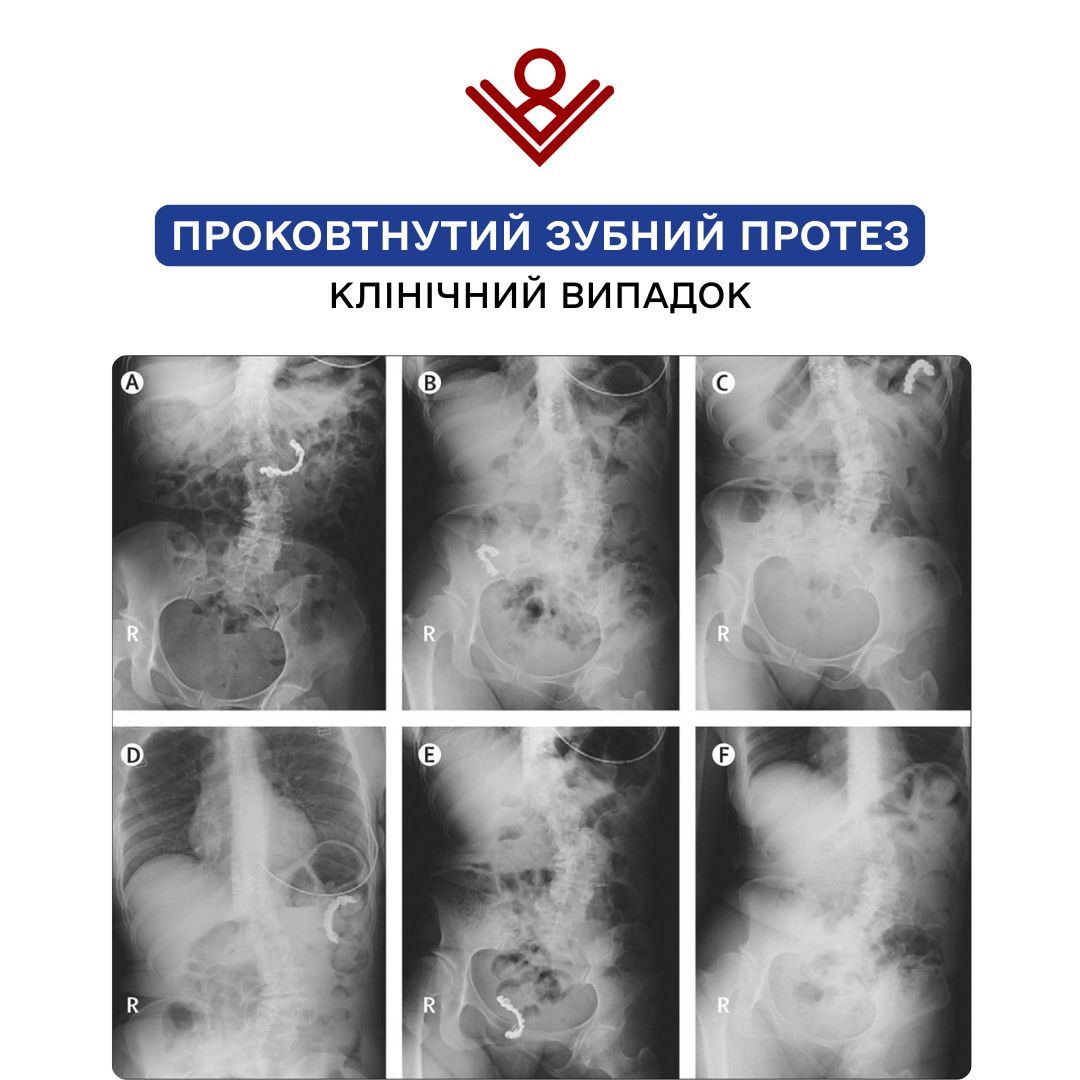 Проковтнутий зубний протез