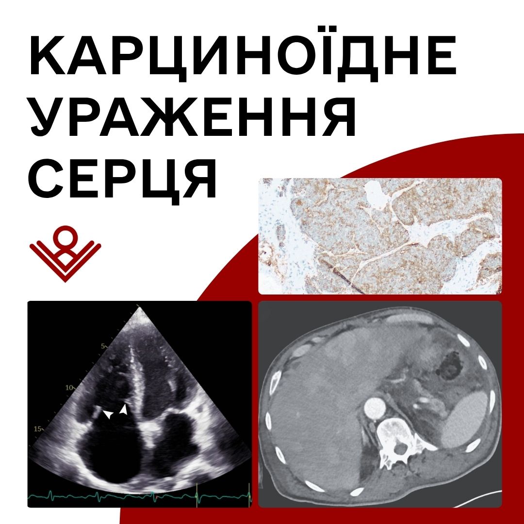 Карциноїдне ураження серця