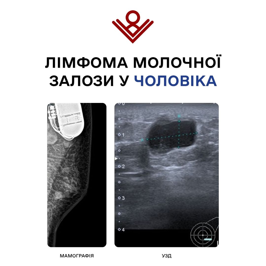 лімфома молочної залози у чоловіка