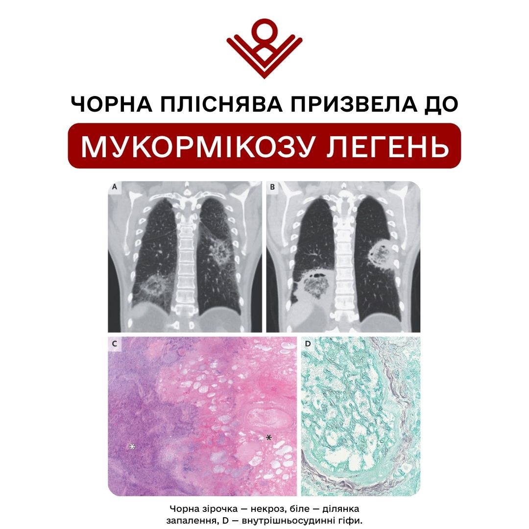 Мукормікоз легень