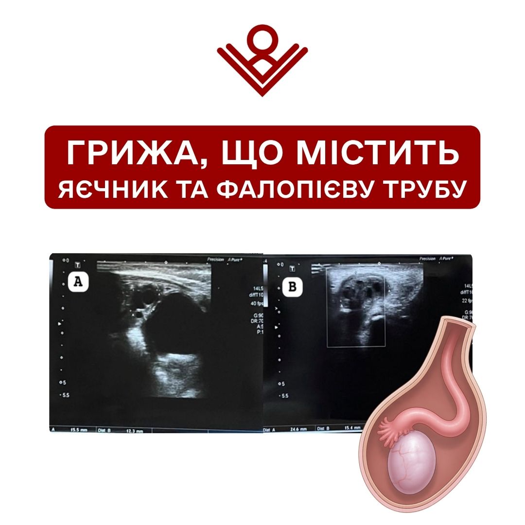 грижа, що містить яєчник та фалопієву трубу