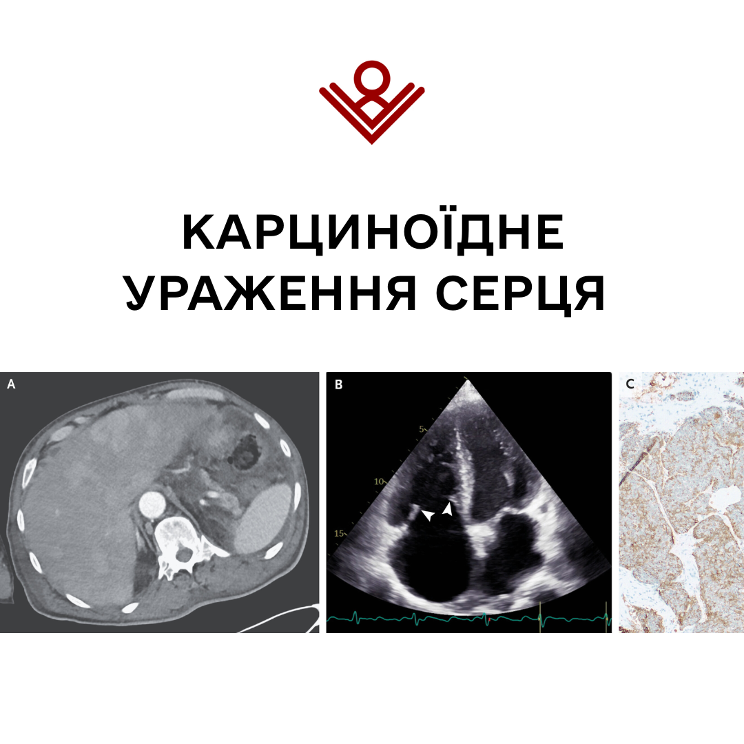 Карциноїдне ураження серця