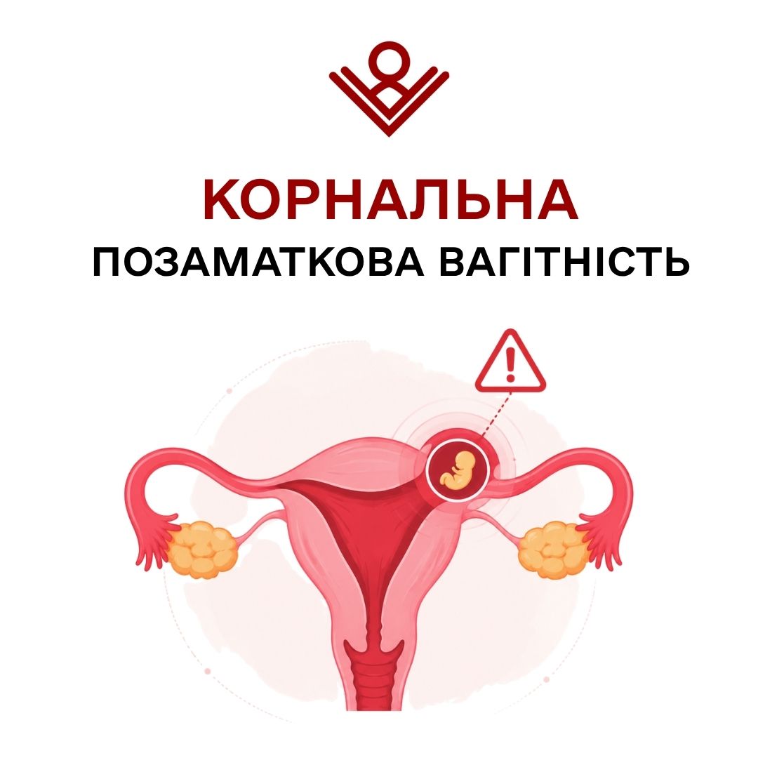 Корнальна позаматкова вагітність
