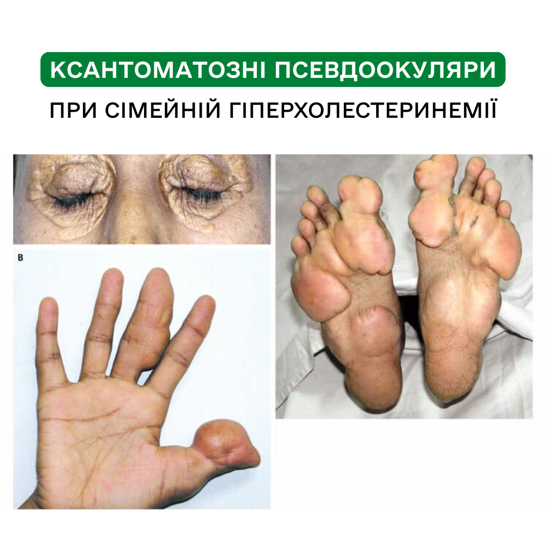 Ксантоматозні псевдоокуляри