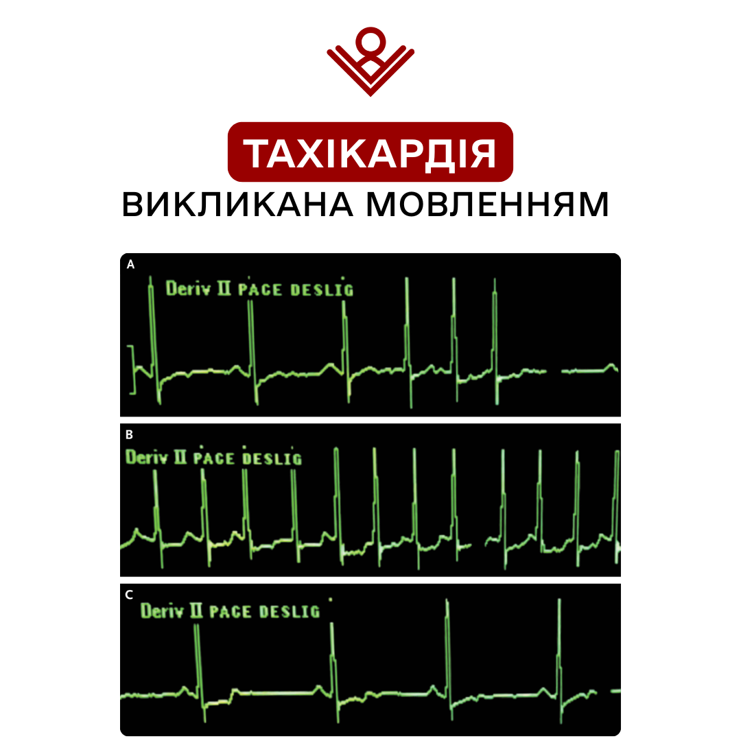 Тахікардія, викликана мовленням