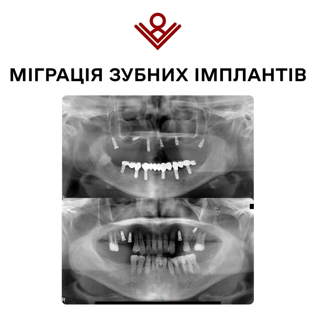 Міграція зубних імплантів