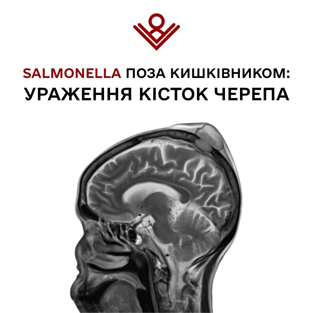 Salmonella поза кишківником: ураження кісток черепа