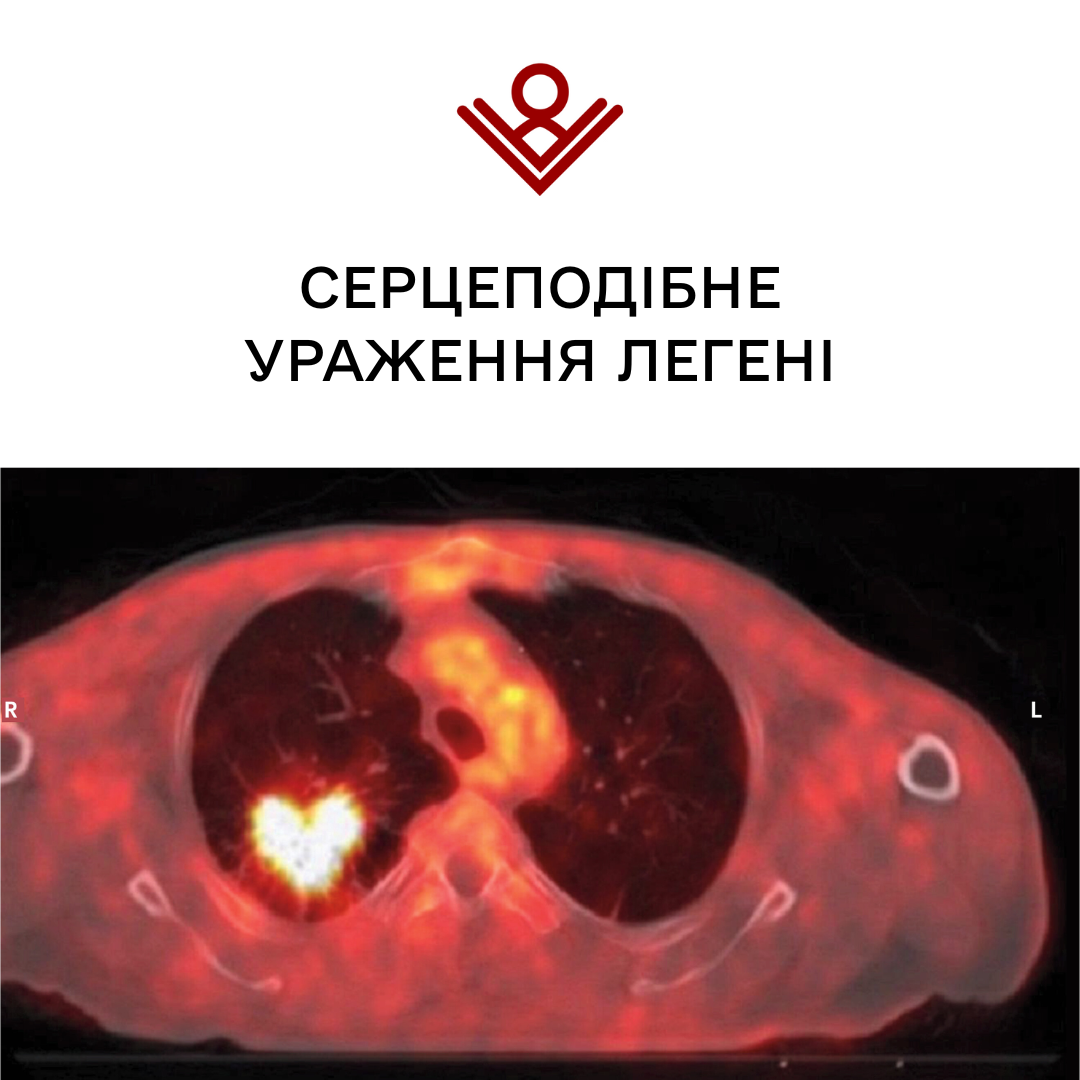 Серцеподібне ураження