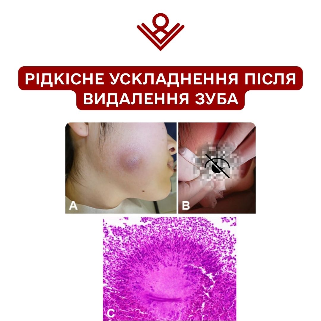 рідкісне ускладнення після видалення зуба