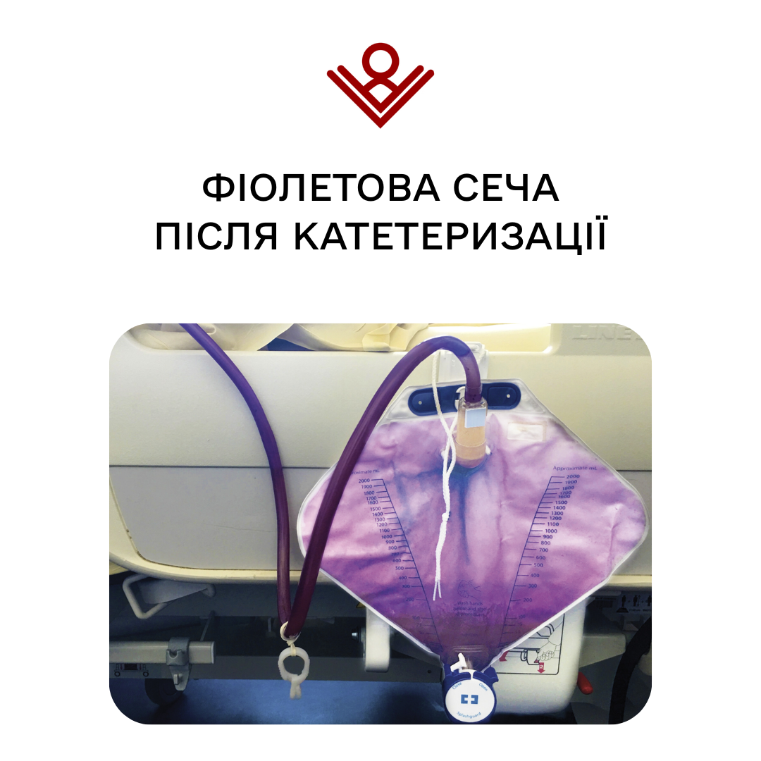 Фіолетова сеча