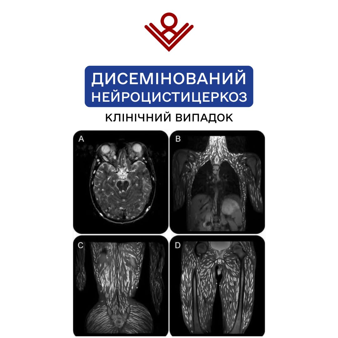 Нейроцистицеркоз