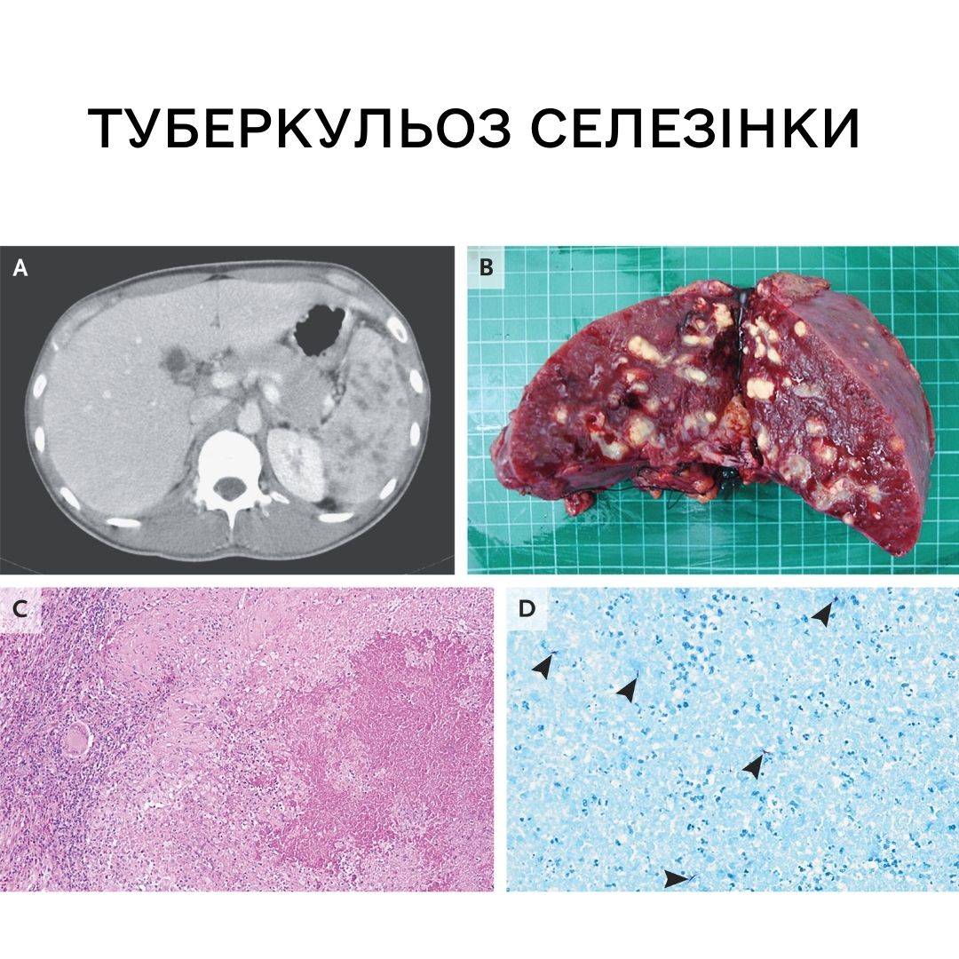 Туберкульоз селезінки