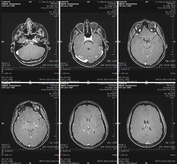 Для чего нужно МРТ головного мозга