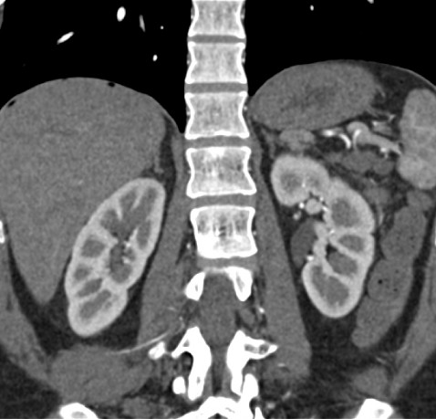 МСКТ легких, брюшной полости и малого таза