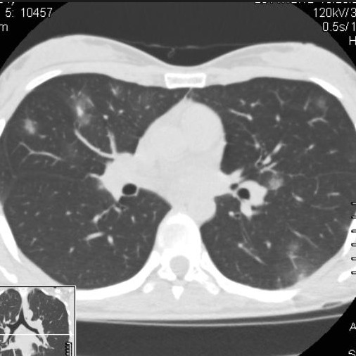 Патологии на КТ