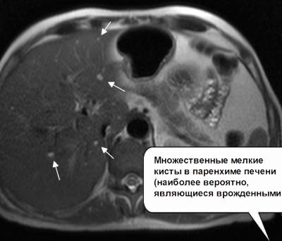 МРТ брюшной полости