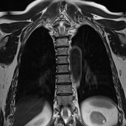 Что показывает МРТ грудного отдела