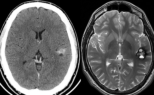 Какое обследование точнее КТ или МРТ