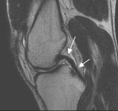 Расшифровка МРТ колена