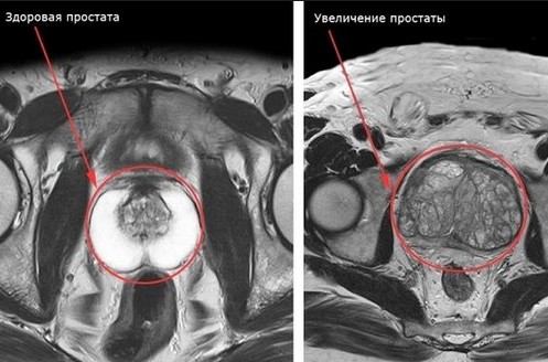 МРТ органов малого таза что показывает