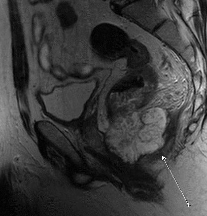 Что видно на МРТ малого таза