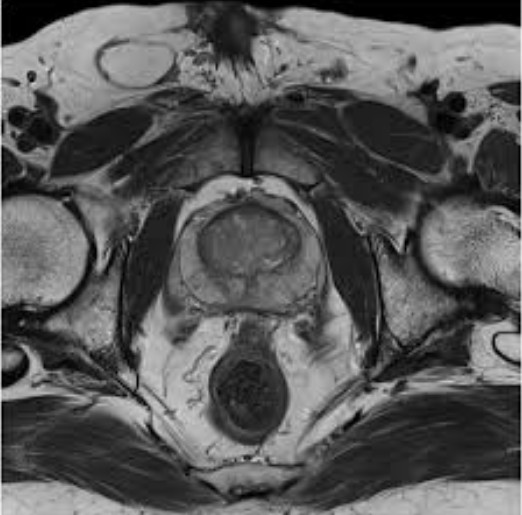 Информативность МРТ малого таза