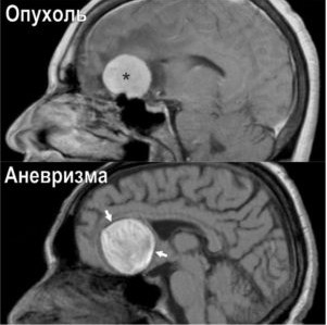 Как выглядит рак на МРТ изображении