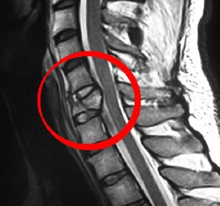 Расшифровка МРТ шейного отдела позвоночника