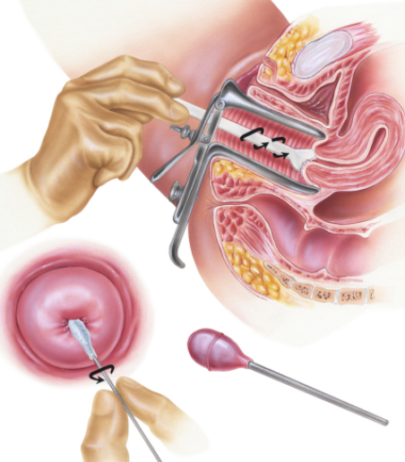ilustración cómo se hace una citología anatomía aparato reproductor