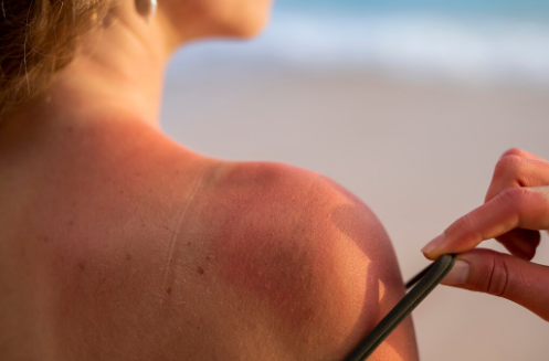 Cilt Lekeleri En Sık Güneş Hasarına Bağlı Nedenlerle Görülür