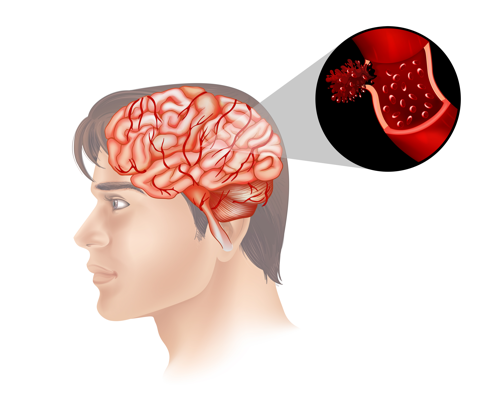 Beyin Kanamaları