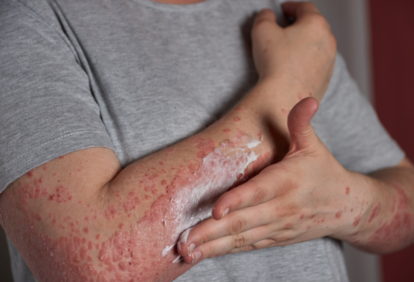 Sedef Hastalığı Her Yaş Grubunda Ortaya Çıkabilir